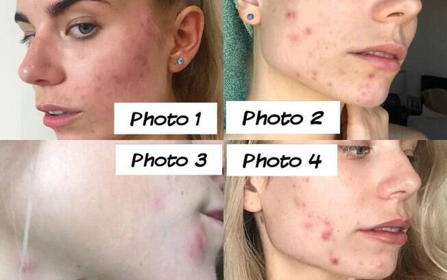 No Instagram, Nicola compartilhou as diferentes fases da acne cística e explicou os motivos de cada uma delas