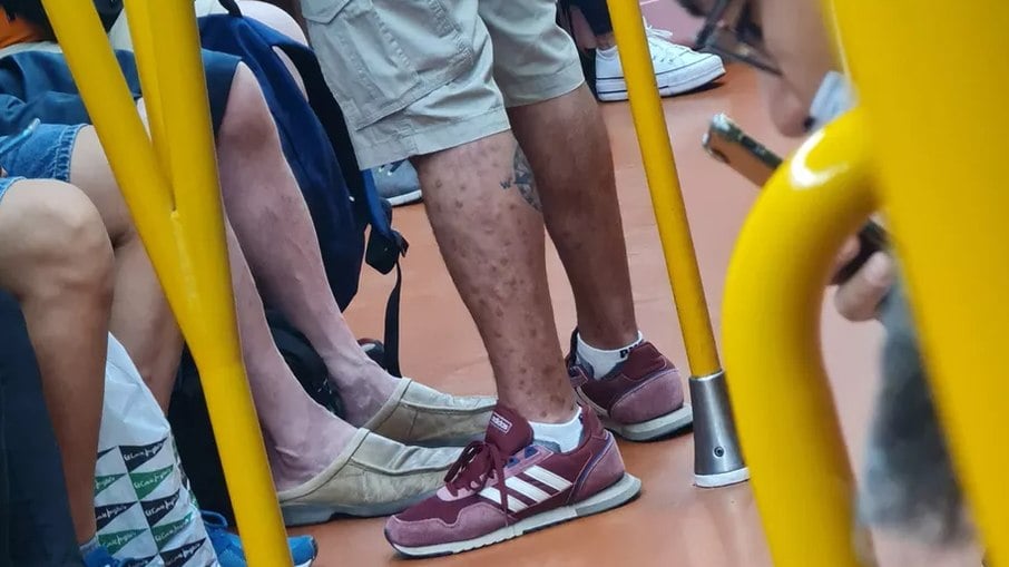 Passageiro com varíola dos macacos andando de metrô em Madri