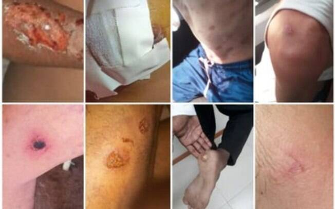 Fotos divulgadas pelo MPF mostram feridas supostamente causadas por agentes penitenciários em presos no Pará