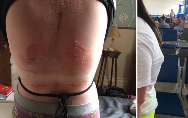 A adolescente ficou com duas bolhas enormes nas costas após sofrer queimaduras solares enquanto estava na praia
