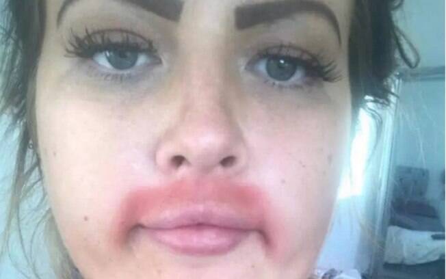 Chantelle ainda tentou aliviar a alergia de depilar o buço com hidratantes e cobriu o 'bigode vermelho' com maquiagem