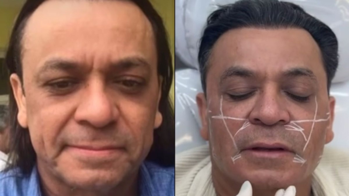 Frank Aguiar passa por nova harmonização facial