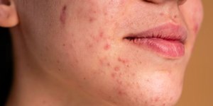 Pessoas com acne enfrentam preconceitos que prejudicam vida social