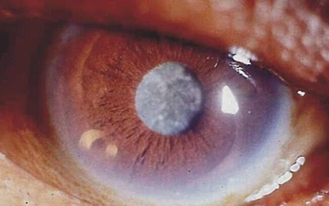 Busca por cirurgia de catarata aumenta com a pandemia