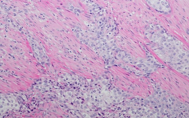 Câncer de bexiga: terapia pode reduzir 53% o risco de morte