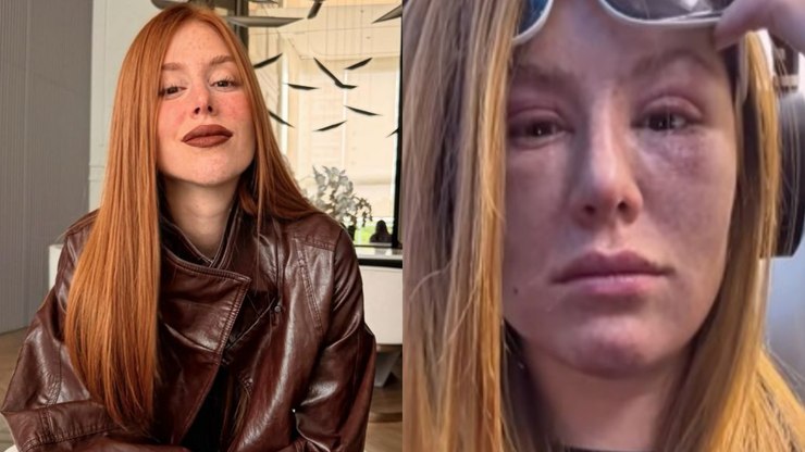 Mari Maria revela tumores abaixo dos olhos: "Achei que ia morrer"