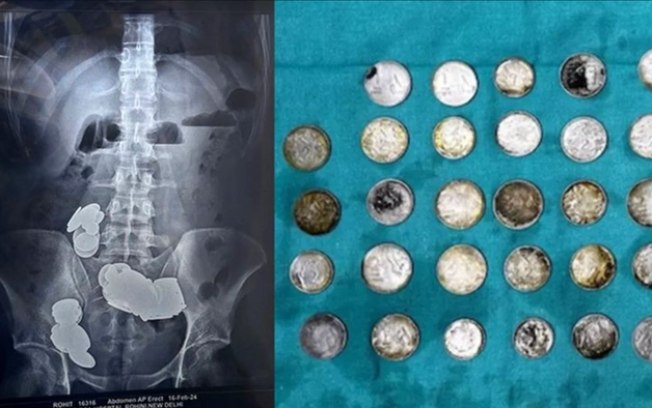 Fisiculturista engole 39 moedas e 37 ímãs para tentar absorver zinco