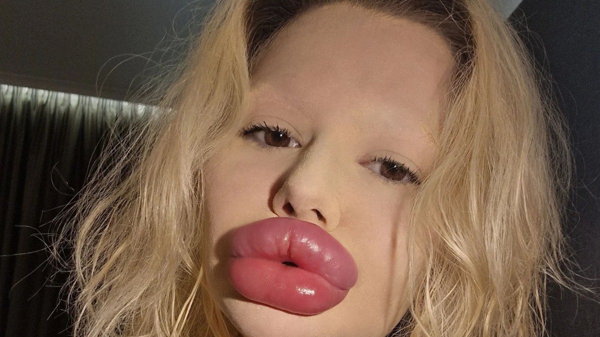 Antes e depois de mulher com lábios gigantes chama atenção da web