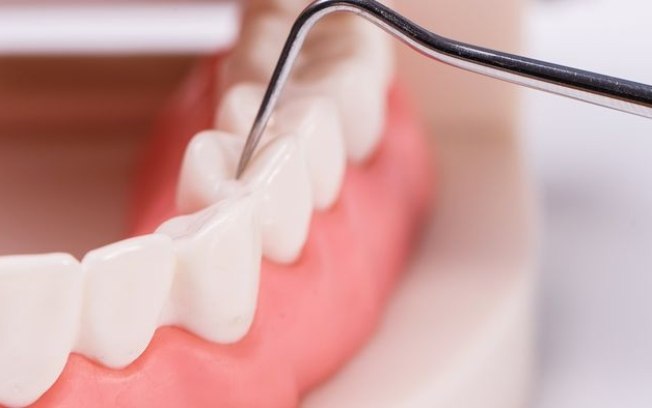 Tecnologia regenerativa pode substituir tratamento de canal no dentista