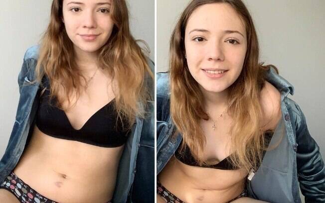 Alice conseguiu vencer a anorexia e, com sua conta do Instagram, quer ajudar pessoas que sofrem com o distúrbio alimentar