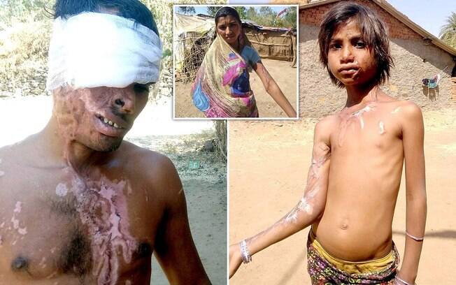 Família indiana sofreu queimaduras de ácido de um homem que estava frustrado por ter sido abandonado pela namorada