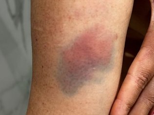Braço da mulher vítima de violência