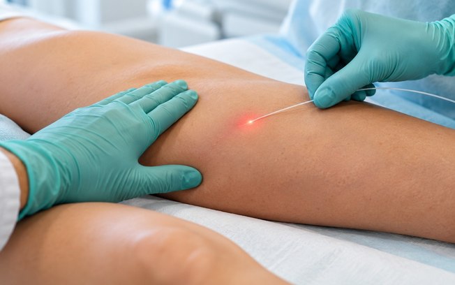 Laser permite tratar a safena sem retirar a veia da perna