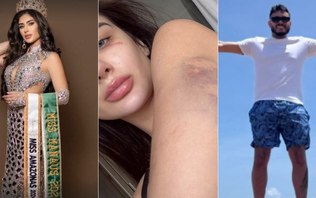Agressor de Miss Amazonas foge de hospital para evitar prisão