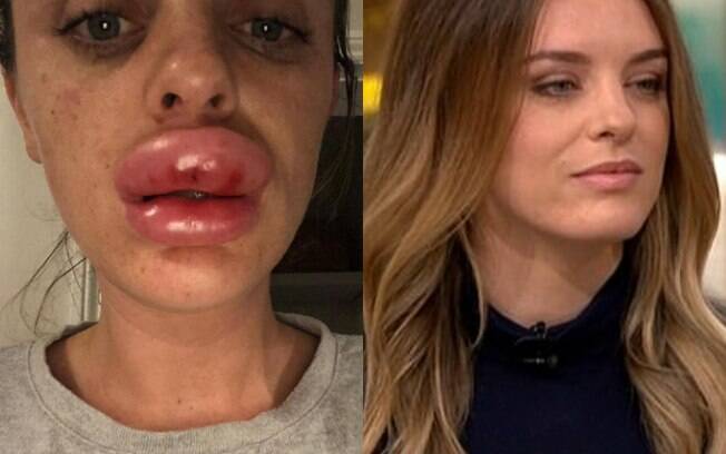Rachael Knappier fez um preenchimento labial, mas o procedimento deu errado e seu lábio ficou quatro vezes maior