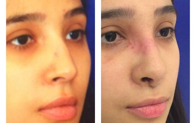 Fotos do antes e depois de uma rinoplastia Fotos do antes e depois de uma rinoplastia