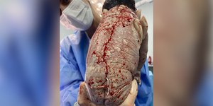 Bebê nasce com DIU preso ao corpo e imagem viraliza na web