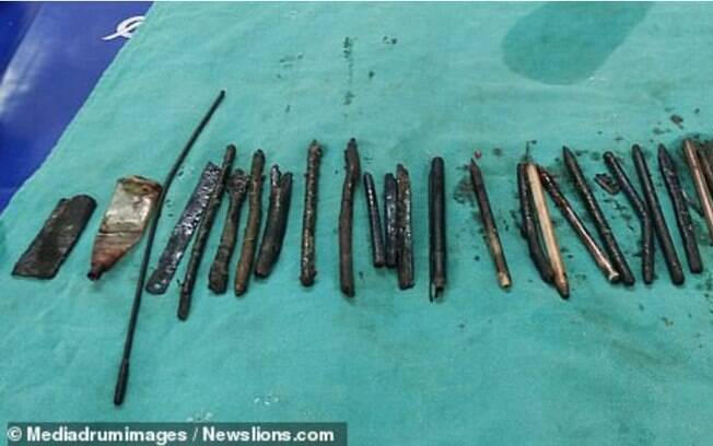 Foto mostra alguns dos objetos que foram retirados durante cirurgia do estômago do indiano Yogesh Thakur, de 30 anos