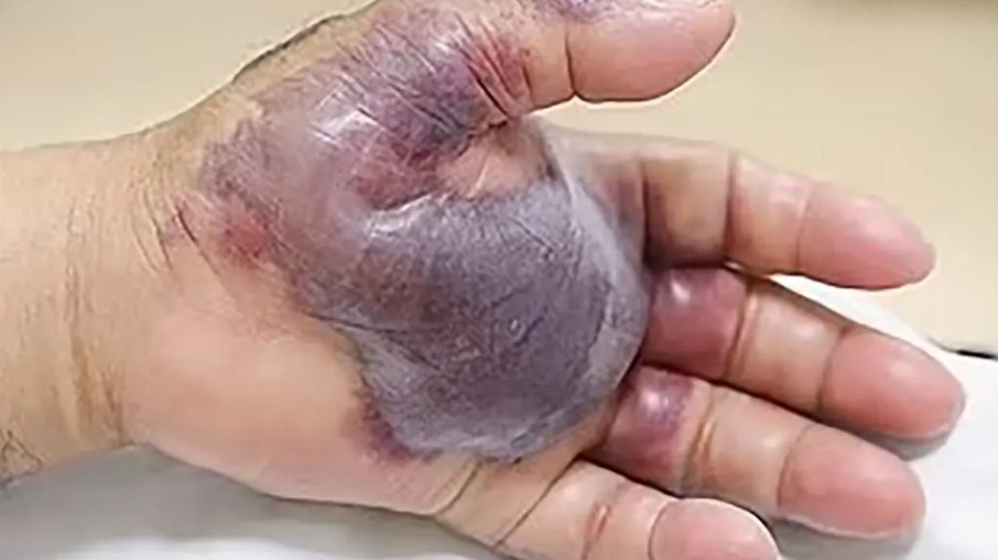 A presença de Vibrio vulnificus no sangue pode causar lesões cutâneas com bolhas.