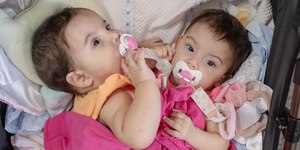 Goiás: gêmeas siamesas são internadas para cirurgia de separação