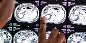 MOGAD: doença autoimune é rara e difícil de diagnosticar