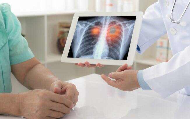 Em 2018, segundo a Organização Mundial de Saúde, o câncer de pulmão causou 1,76 milhão de mortes em todo o mundo