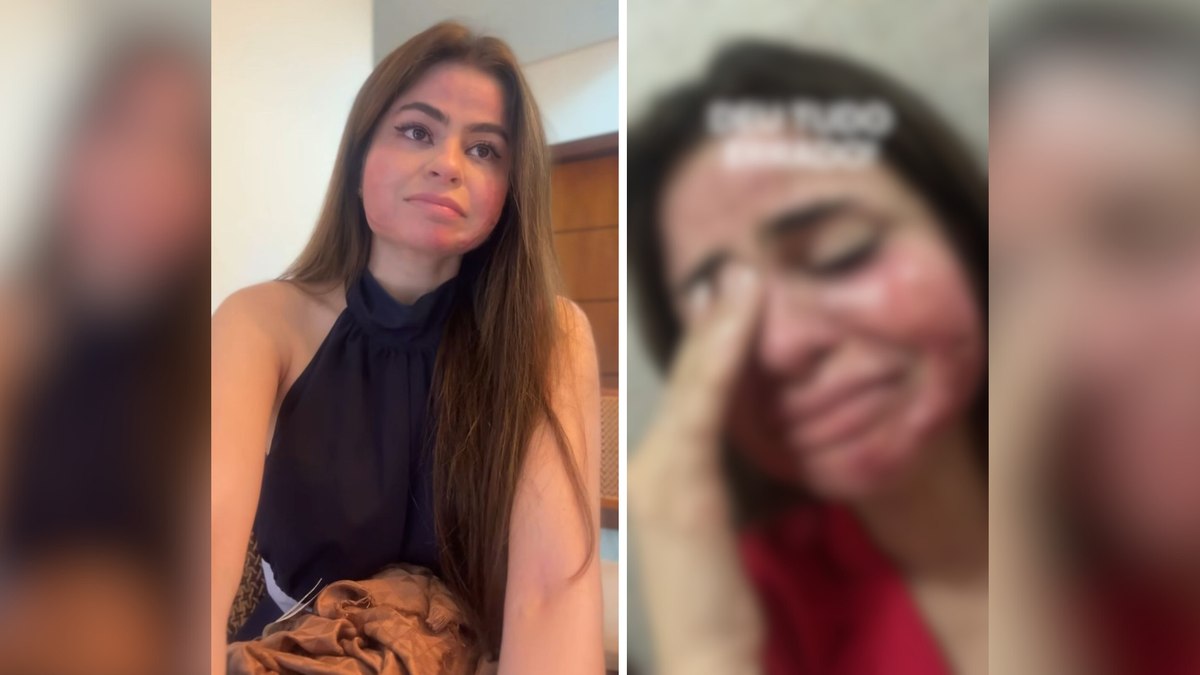 Mulher desenvolve lesões no rosto após procedimento estético Mulher desenvolve lesões no rosto após procedimento estético