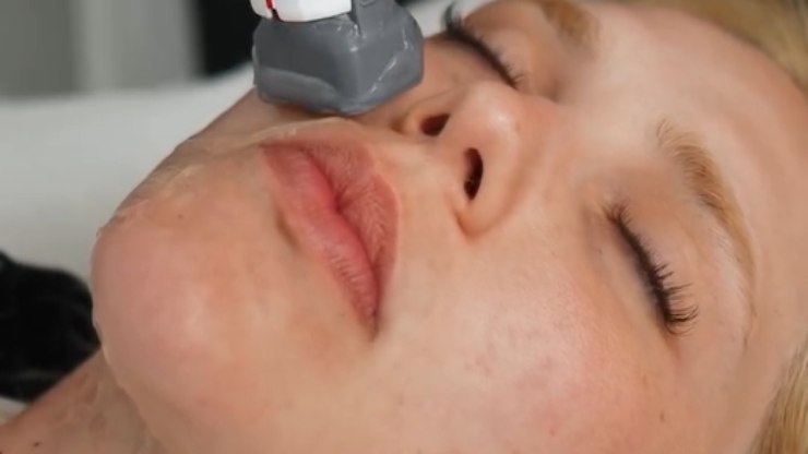 Aos 27 anos, Virginia faz procedimento para rejuvenescer o rosto
