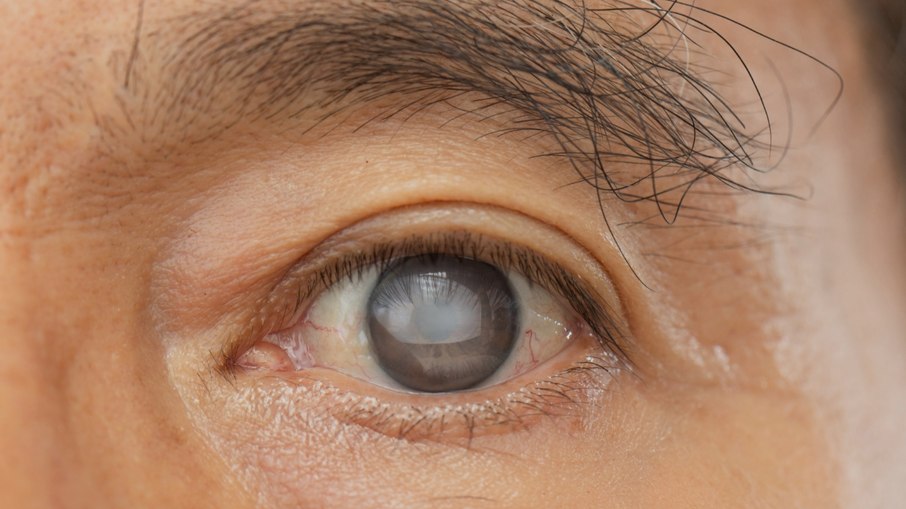 Visão embaçada, sensibilidade à luz e dificuldade para enxergar à noite estão entre os possíveis sinais de catarata. Visão embaçada, sensibilidade à luz e dificuldade para enxergar à noite estão entre os possíveis sinais de catarata.