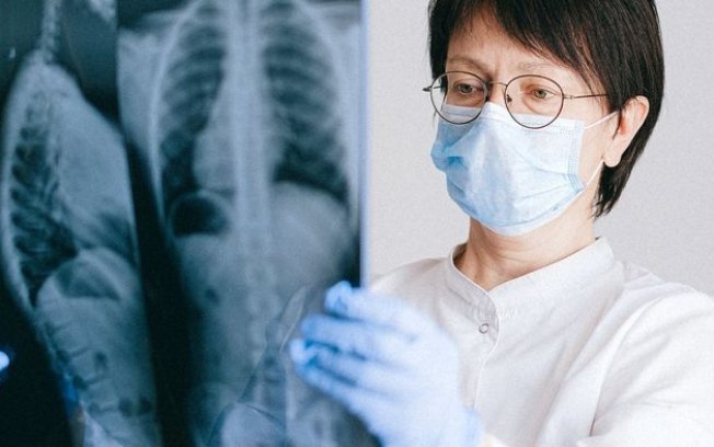 IA analisa raio-X e aponta risco de câncer de pulmão