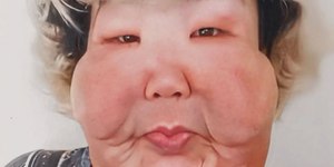 Juju do Pix realiza a primeira cirurgia após ter rosto deformado