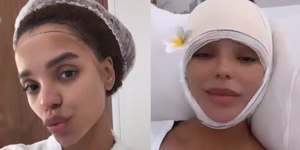 Entenda cirurgia feita por Brunna Gonçalves para diminuir testa