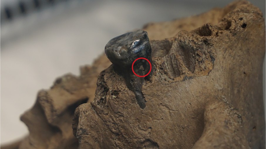 Dente do crânio de Harbin, do qual foi extraída a amostra de cálculo dentário que possibilitou a captura e sequenciamento do mtDNA Dente do crânio de Harbin, do qual foi extraída a amostra de cálculo dentário que possibilitou a captura e sequenciamento do mtDNA