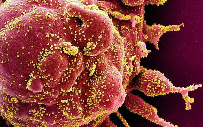 Uma célula apoptótica fortemente infectada com coronavírus, em amarelo