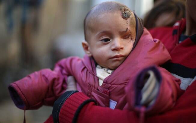 Bebê Karim perdeu o olho esquerdo na Síria