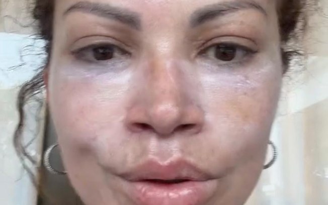 Solange Almeida mostra resultado de lifting facial: “Nova fase” - Tá na ...