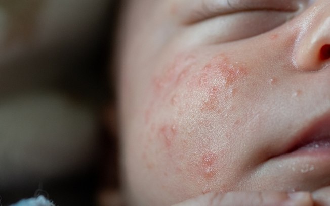 O que é acne neonatal? Entenda os sintomas e tratamento