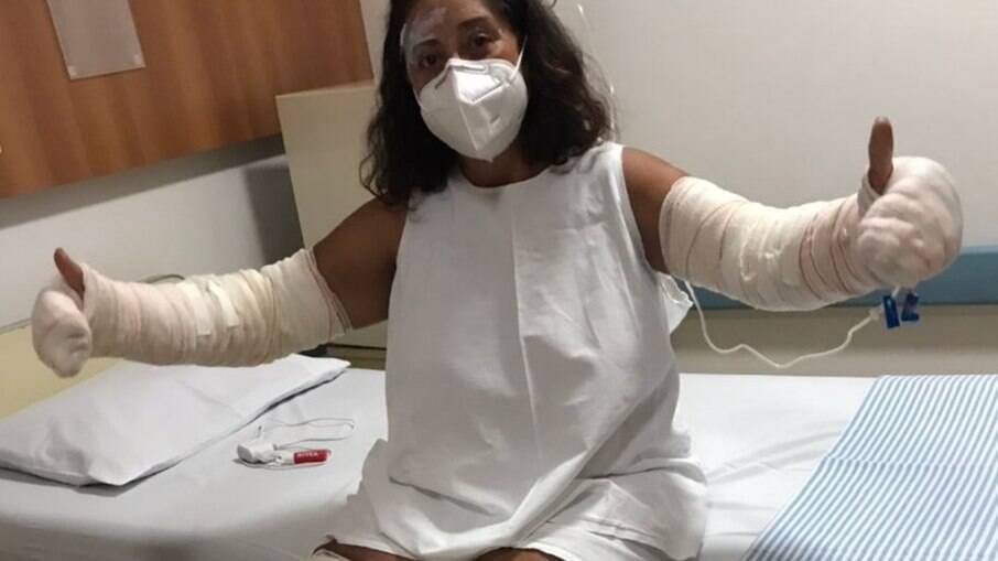 Marlene Batista queimou 40% do corpo após explosão de desodorante