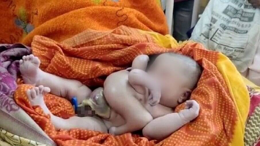 Bebê nasce com quatro braços e quatro pernas na Índia