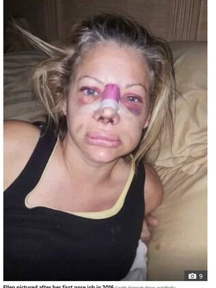 Ellen depois das plásticas em 2016