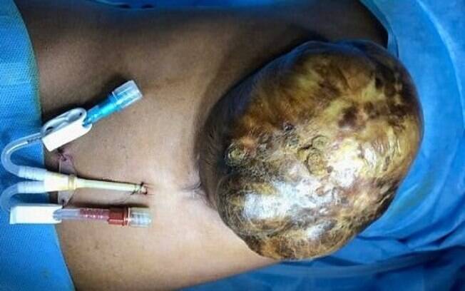 Os órgãos para fora do corpo eram o fígado inteiro da jovem e também parte de seu intestino Os órgãos para fora do corpo eram o fígado inteiro da jovem e também parte de seu intestino