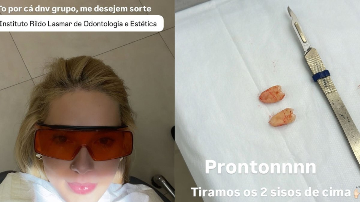 Virginia passa por cirurgia para a retirada dos sisos após sofrer com fortes dores por dois dias. Virginia passa por cirurgia para a retirada dos sisos após sofrer com fortes dores por dois dias.