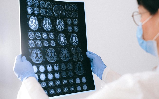 BrainAge: tecnologia indica a idade cerebral
