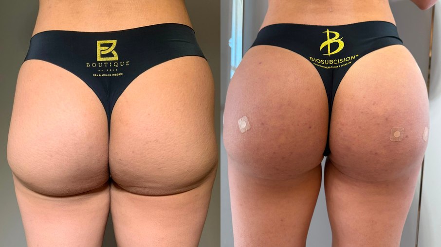 Antes e depois de paciente asiática após procedimento realizado pela Dra. Mariana Ribeiro com a técnica BioSubcision