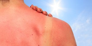 Insolação: Veja como tratar os sintomas e diminuir o calor