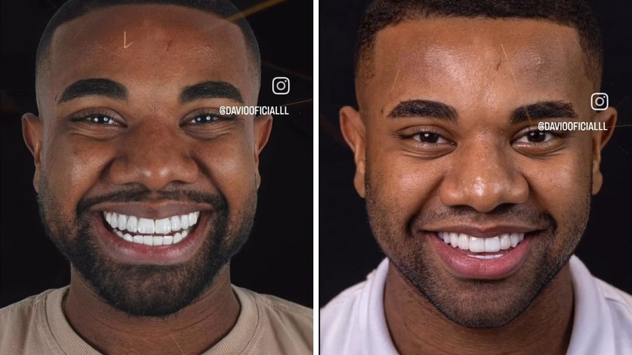 Davi Brito muda lentes dos dentes e revela transformação de R$ 60 mil Davi Brito muda lentes dos dentes e revela transformação de R$ 60 mil
