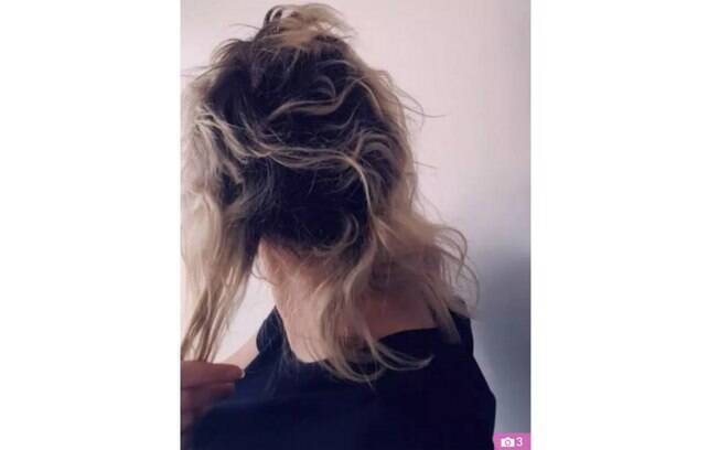 Cabelo de Jessica após os procedimentos capilares. “Disseram para eu raspar o cabelo por causa dos danos”