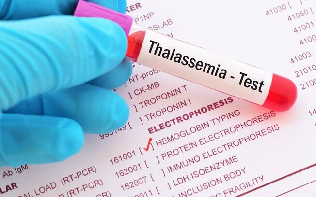 Talassemia é uma doença genética rara que afeta a produção de hemoglobina, podendo causar a morte quando não tratada Talassemia é uma doença genética rara que afeta a produção de hemoglobina, podendo causar a morte quando não tratada
