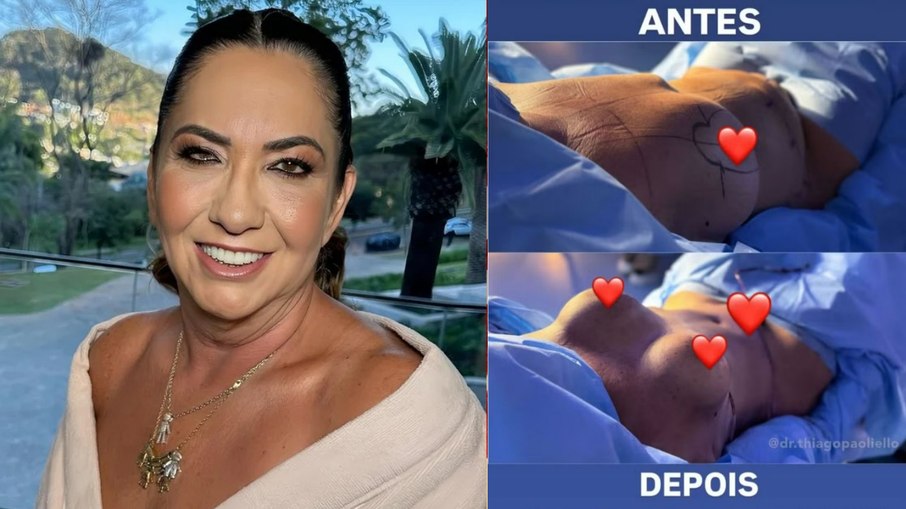 Margareth Serrão mostra antes e depois de cirurgia