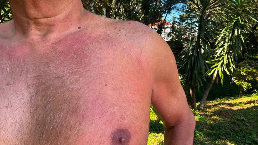 Fernando Munhoz mostra a cicatriz para colocação do marcapasso
